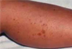 Leukocytoclastic Vasculitis