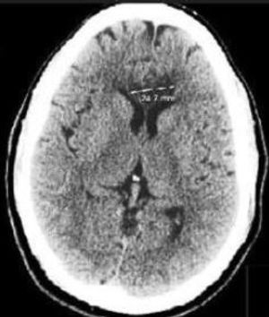 Bilateral Corpus Callosum Stroke