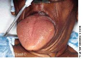 Anaphylaxis Presenting as Macroglossia