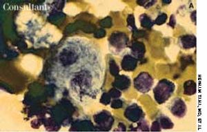 Gaucher's Disease