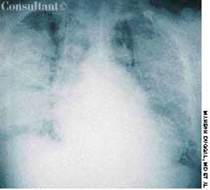 Adult Respiratory Distress Syndrome