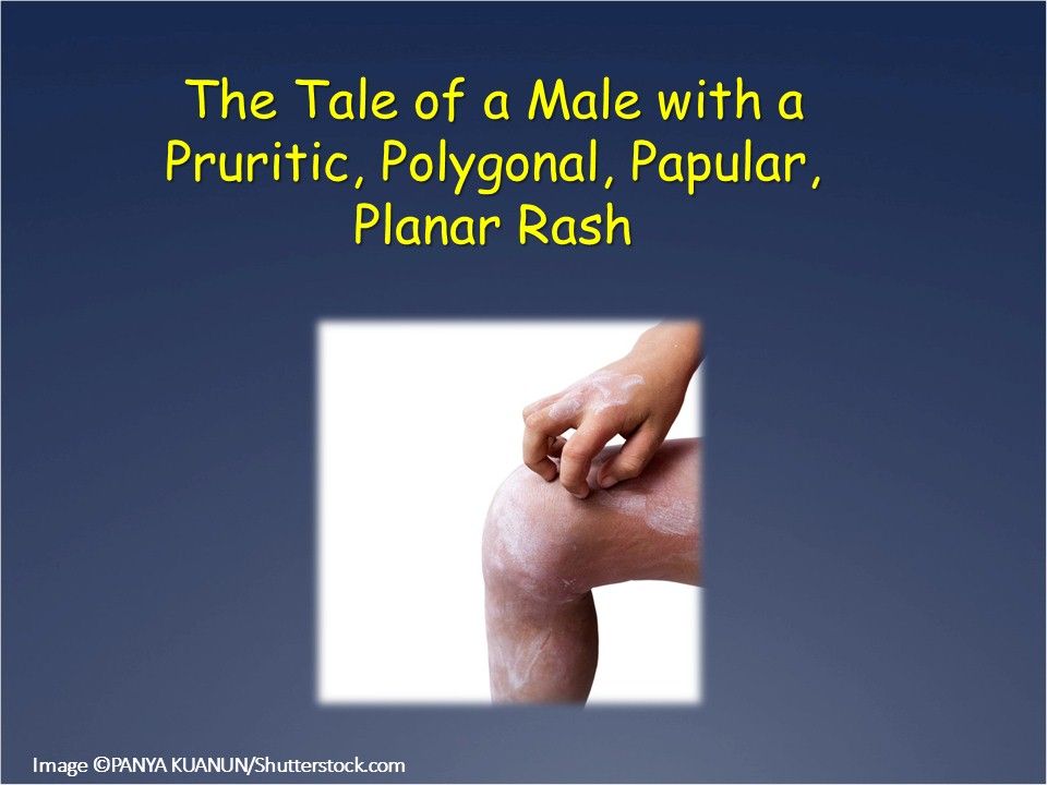 A Pruritic, Polygonal, Papular, Rash on a 10-year-old Boy