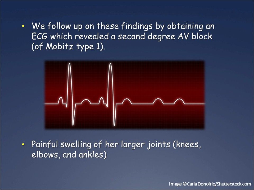 ECG: Revealed a second degree AV block (of Mobitz type 1).