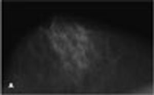 High-Grade Ductal Carcinoma In Situ