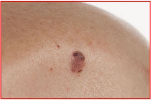 Actinic Keratosis and Squamous Cell Carcinoma: Photodamage in Progress