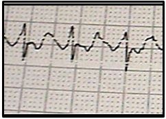 Atrial flutter