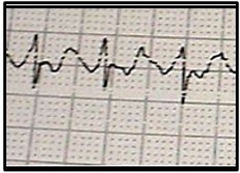 Atrial flutter
