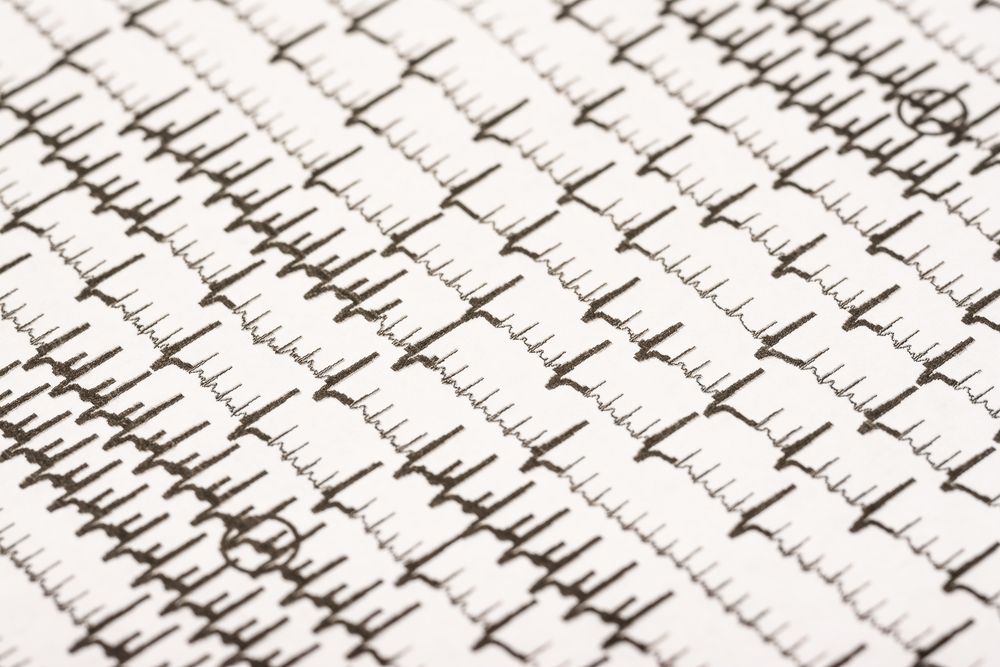 Exercise tolerance in AF affected by gender. 