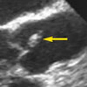 Cryptogenic Stroke