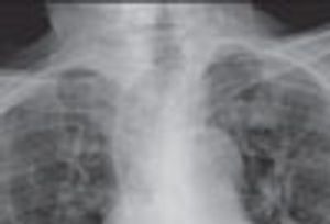 Gastric Outlet Obstruction Shown in Barium Swallow Study