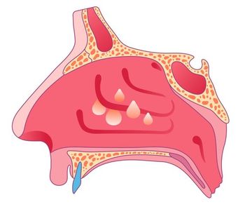 Novel resorbable sinonasal implant significantly reduces symptoms in treatment / image credit ©Takoyaki Shop resistant CRS / 