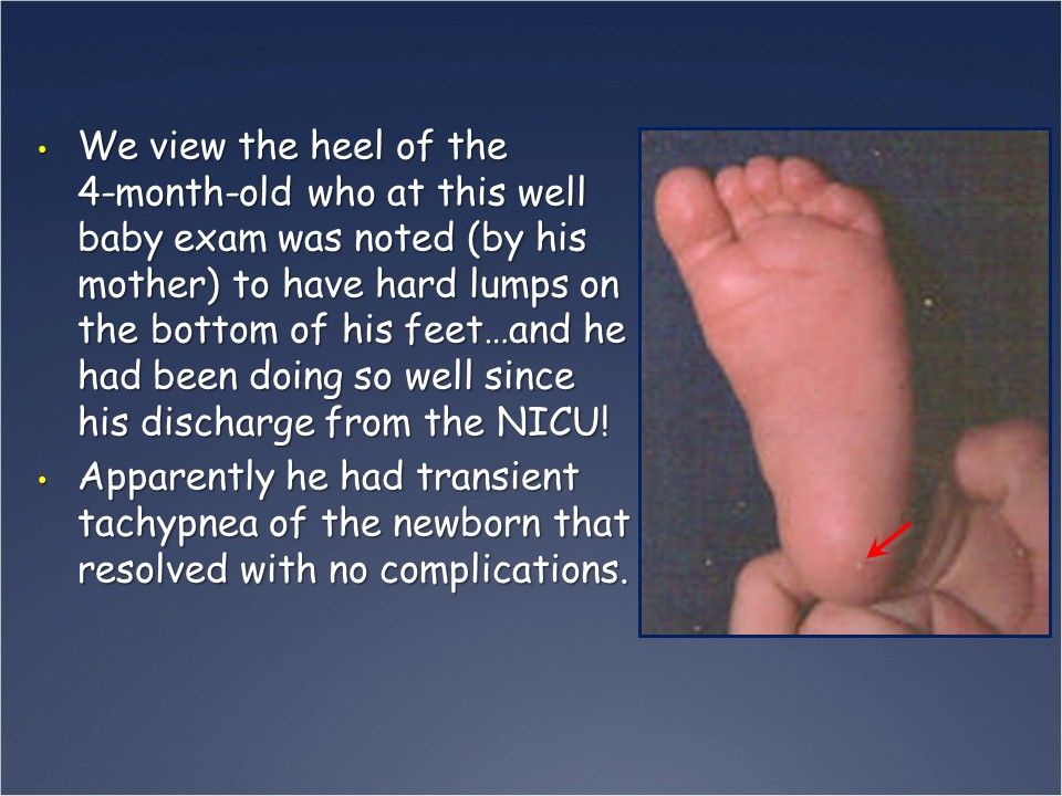 A Case Of A Baby With Bumpy Feet