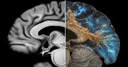 J&J's Investigational Anti-Tau Alzheimer Drug Posdinemab Fails to Meet Primary Endpoint in Phase 2b Trial