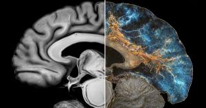 J&J's Investigational Anti-Tau Alzheimer Drug Posdinemab Fails to Meet Primary Endpoint in Phase 2 Trial / image credit ©Useful Items/stock.adobe.com Generated with AI