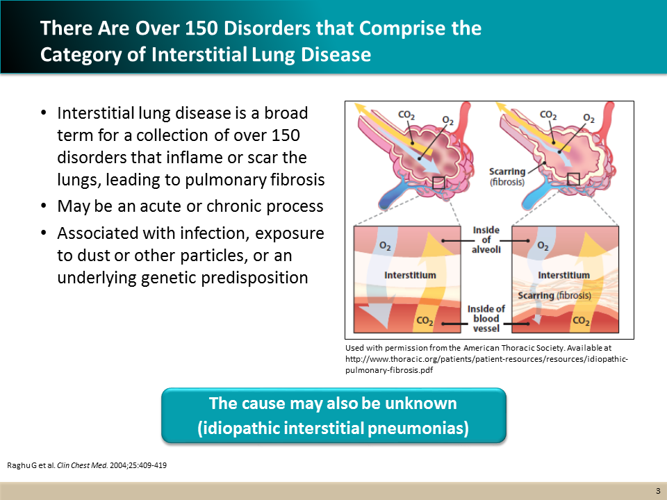 An Introduction To Idiopathic Pulmonary Fibrosis 1130