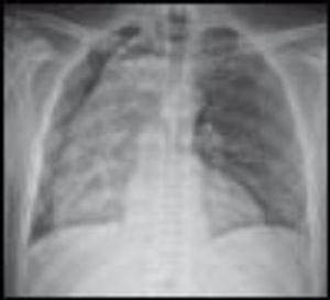 Massively Dilated Esophagus