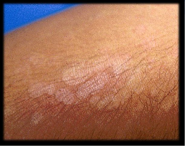 Tinea Skin Rash