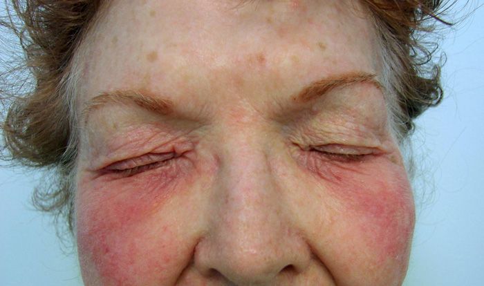 Allergy To Eye Drops