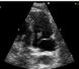 Benign Papillary Fibroelastoma: A Not-So-Rare Primary Cardiac Tumor?