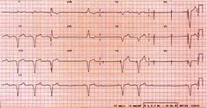 Pacemakers and AICDs: The ABCs