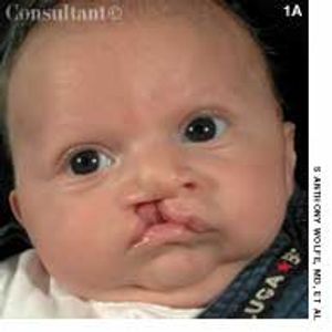 Cleft Lip and Palate