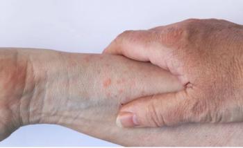 Global Burden of Atopic Dermatitis in Older Adults Underestimated and Expected to Rise Substantially by 2050  / image credit  ©Astrid Gast/stock.adobe.com