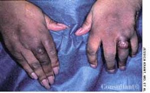 Rheumatoid Nodules in a 65-Year-Old Woman