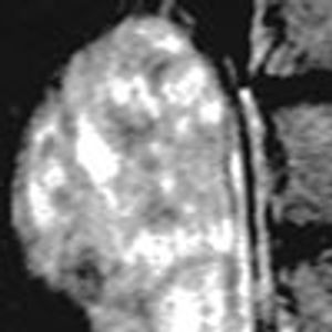 A Right Adrenal Serpent