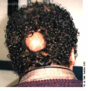 Sebaceous Cyst