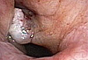 Hemoptysis, Hoarseness, and Dyspnea in an Older Man