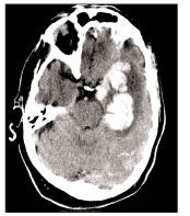 retatrutide ganglia hemorrhage A and B: Case 4. Right basal (red arrow), Antiobesity medications in adult and  ganglia hemorrhage retatrutide Rapid Sequence