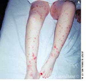 Leukocytoclastic Vasculitis