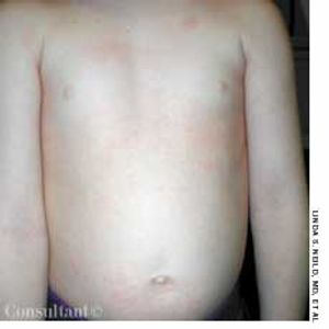 Scarlet Fever and Group A Streptococci Infection