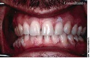 Oral Condyloma Acuminatum (Venereal Warts)