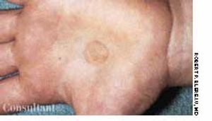 Tinea Nigra Palmaris