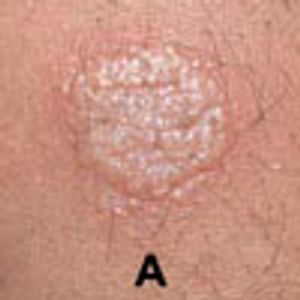 Atypical Tuberculin Skin Test Responses