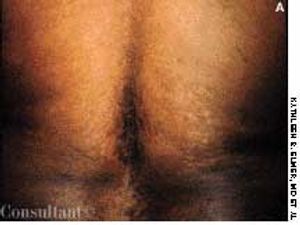 Confluent and Reticulated Papillomatosis