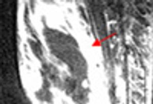 Diabetic Myonecrosis: A Rare Complication of Type 2 Diabetes