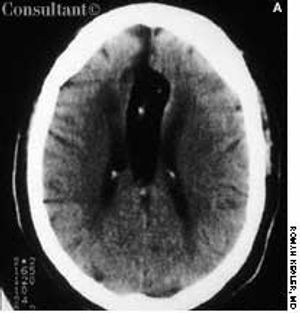 CNS Lipoma