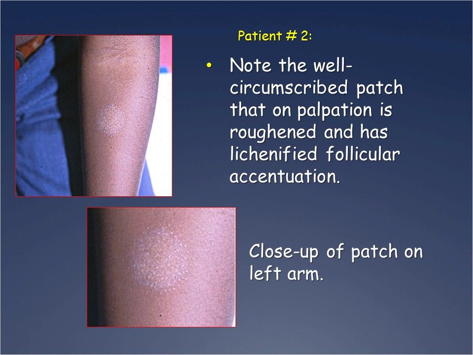 Lichenoid Eruptions: Can You Match that Rash with the Dx?