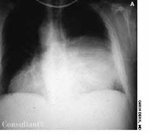 Posterior Mediastinal Thymoma