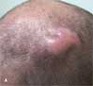 Perifolliculitis Abscedens Et Suffodiens