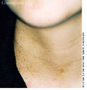 Zosteriform Lentiginous Nevus