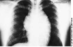 T-Cell Acute Lymphoblastic Leukemia and Mediastinal Mass