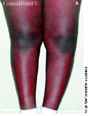 Blount Disease