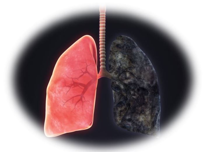 Lung Cancer Survival Improved Significantly Based on Early CT Screening ...