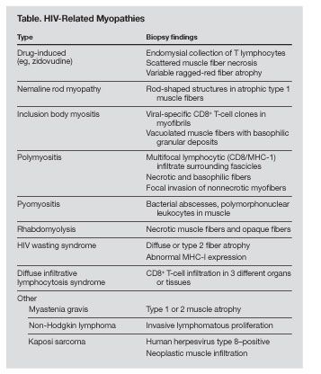 Hiv Associated Nemaline Rod Myopathy Role Of Intravenous Immunoglobulin Therapy In Two Persons With Hiv Aids Hiv Associated Nemaline Rod Myopathy Role Of Intravenous Immunoglobulin Therapy In Two Persons With Hiv Aids