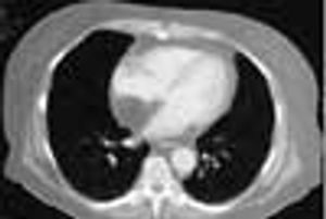 Mediastinal Lipomatosis
