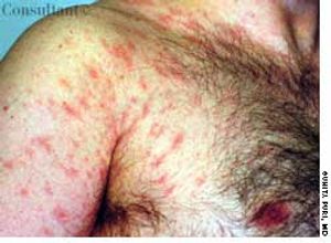Pityriasis Rosea on Chest, Neck, and Back of a 35-Year-Old Man