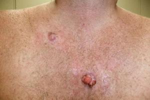 Basal Cell Carcinoma 